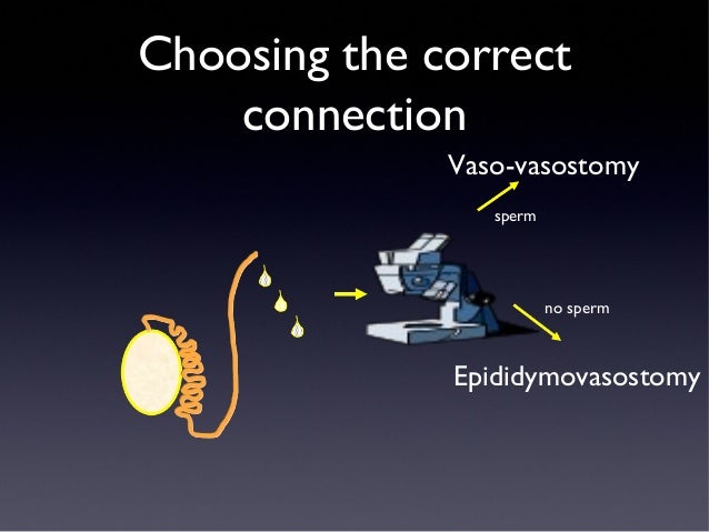 Extract sperm from vasectomy patient